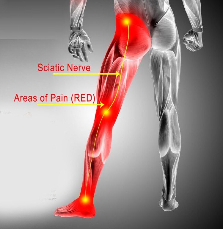Strengthen your core, ease pain.  Sciatica exercises, Nerve pain